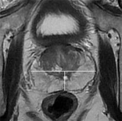 Prediction of extracapsular extension in prostate cancer using the Likert scale combined with clinical and pathological parameters